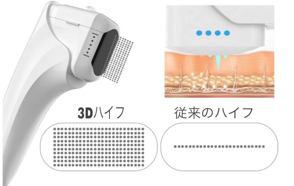 3Dハイフと従来のハイフ