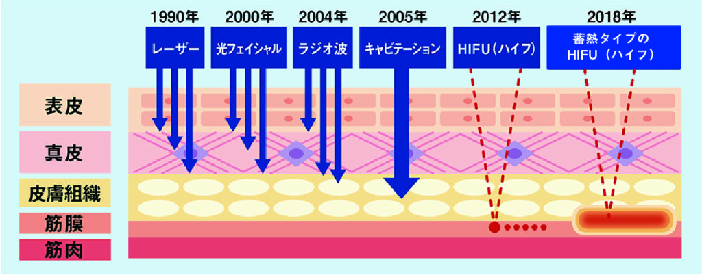 ハイフ解説図